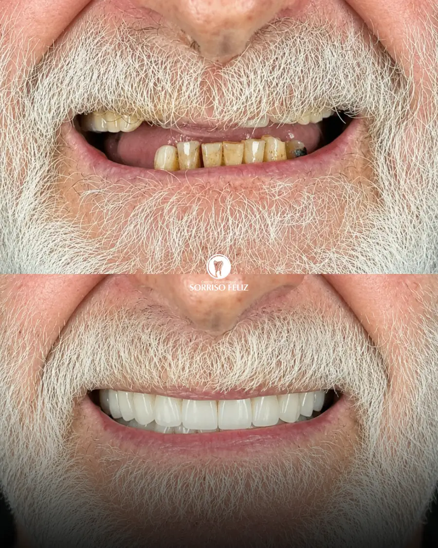 Comparação antes e depois de reabilitação com implantes e prótese protocolo em paciente da clínica
