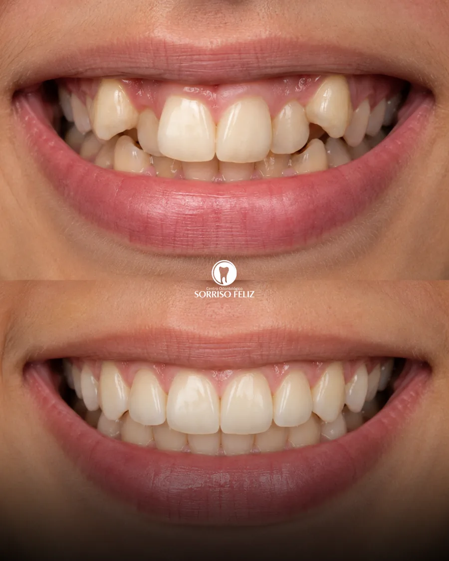 Comparação antes e depois de tratamento ortodôntico em paciente da clínica